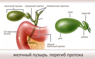 Что это такое перегиб желчного пузыря и причины его образования