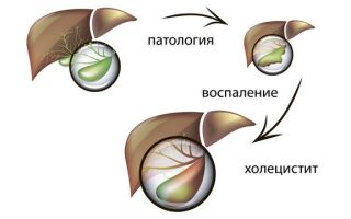 Воспаление желчного пузыря — признаки, лечение и диета