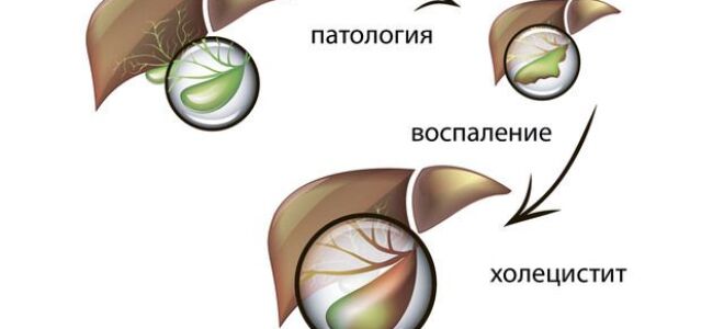 Воспаление желчного пузыря — признаки, лечение и диета
