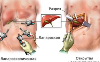 Как вывести камни из желчного пузыря без операции народными методами