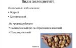 Как лечить холецистит