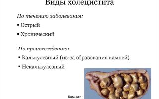 Как лечить холецистит