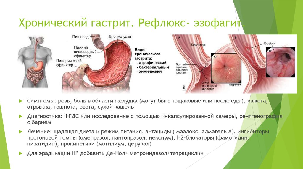 Определение и анатомия гастрита и эзофагита