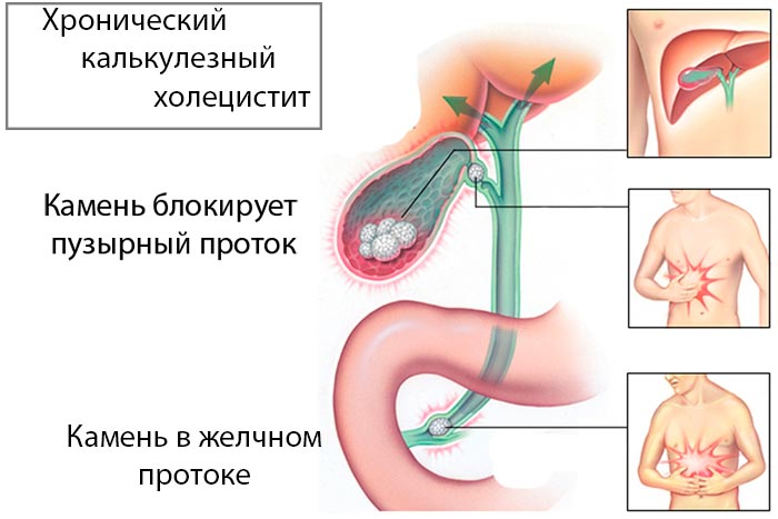 Калькулезный холецистит симптомы и лечение боль в нижних ребрах справа сзади со спины