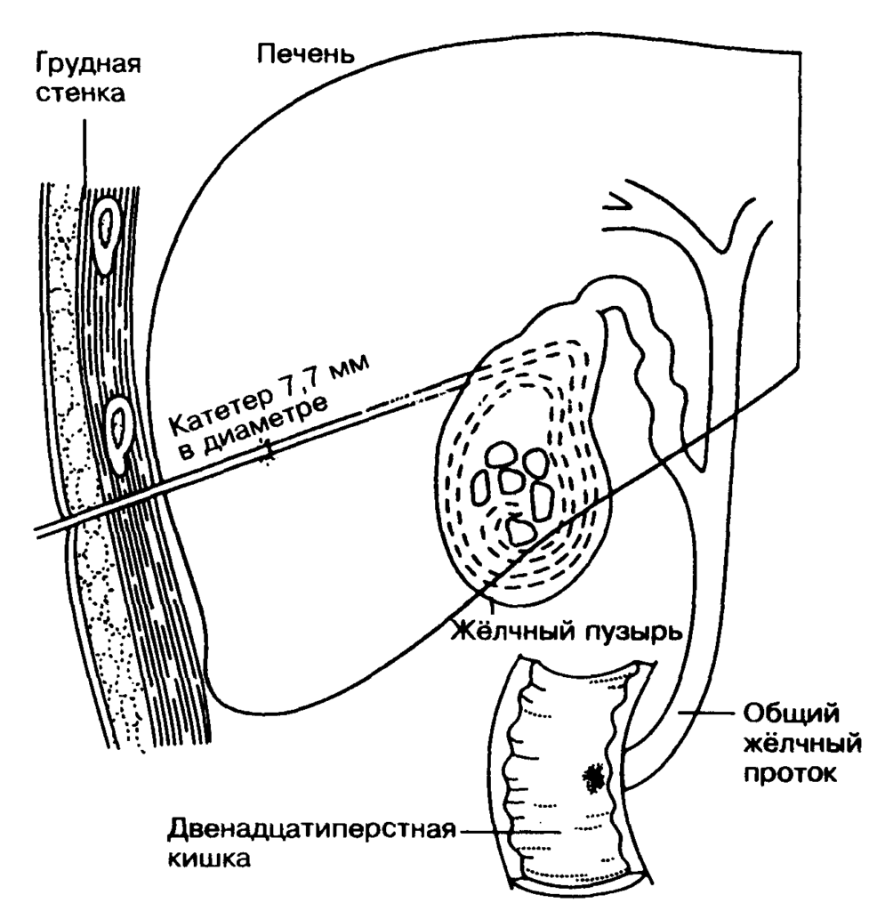 Операции на желчном пузыре и желчных протоках. Литолиз желчных камней. Катетеризация желчного пузыря. Катетер в желчном пузыре.