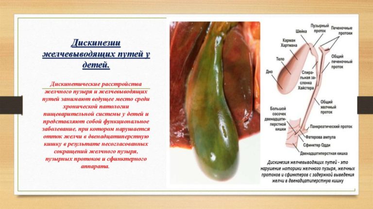 Дискинезия желчевыводящих путей картинки