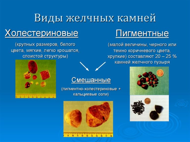 Какие камни бывают в желчном пузыре по составу фото и названия